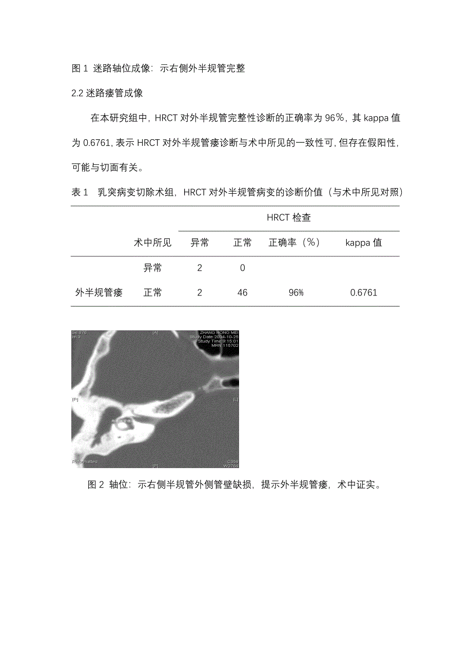 高分辨率CT不同重建技术评估迷路瘘管的价值.doc_第3页