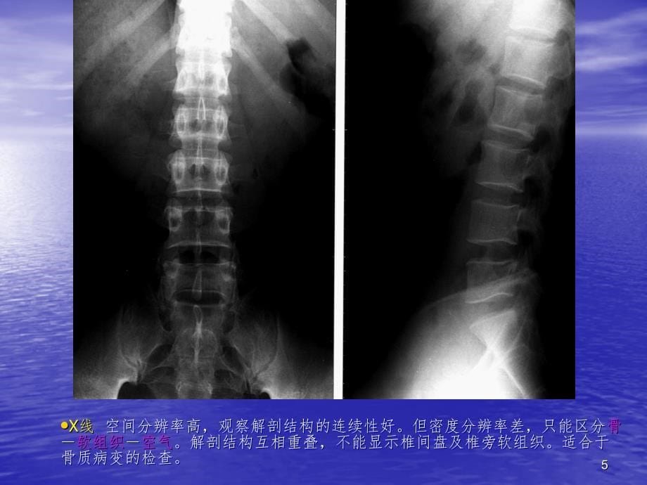 脊柱病变影像诊断课堂PPT_第5页