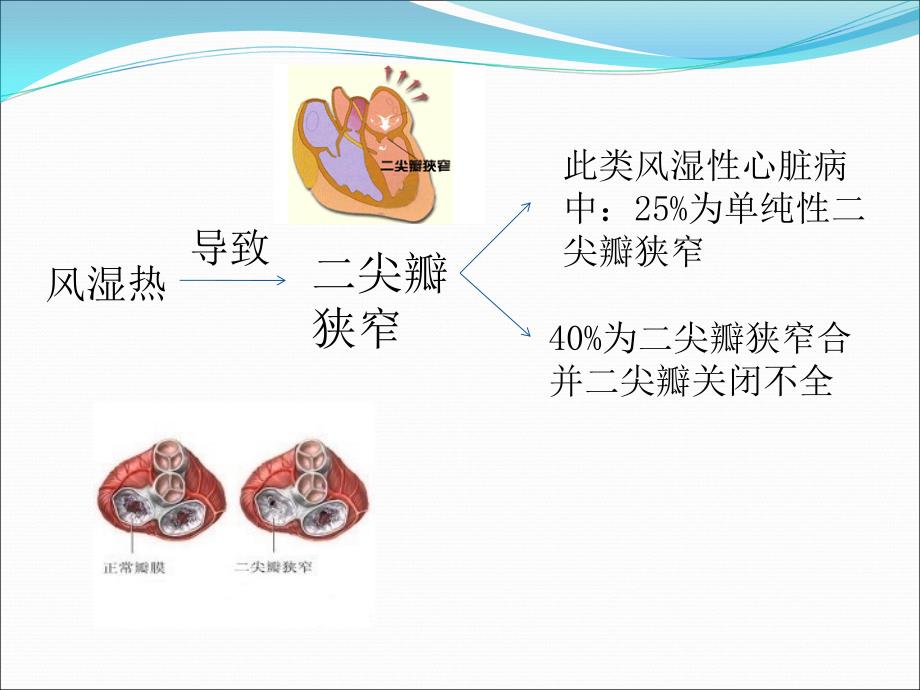 医学专题：二尖瓣狭窄伴关闭不全导致的症状_第4页