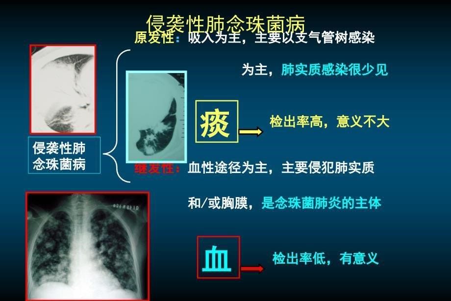 [基础医学]肺部真菌感染的困惑和挑战2nanchang_第5页