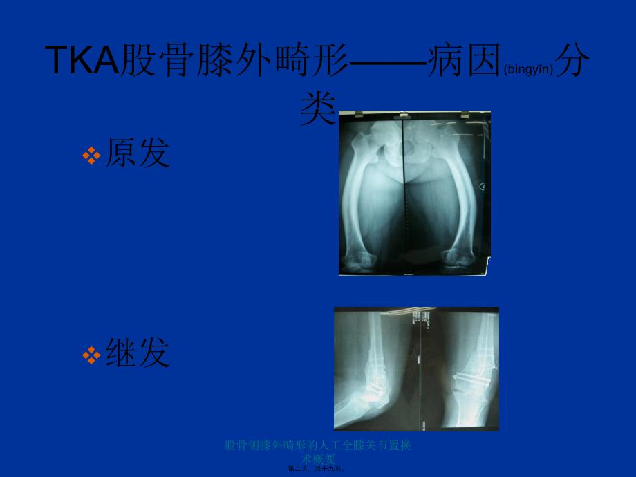 股骨侧膝外畸形的人工全膝关节置换术概要课件_第2页