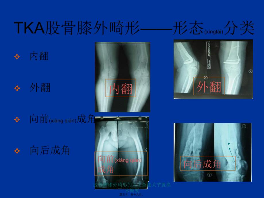 股骨侧膝外畸形的人工全膝关节置换术概要课件_第3页