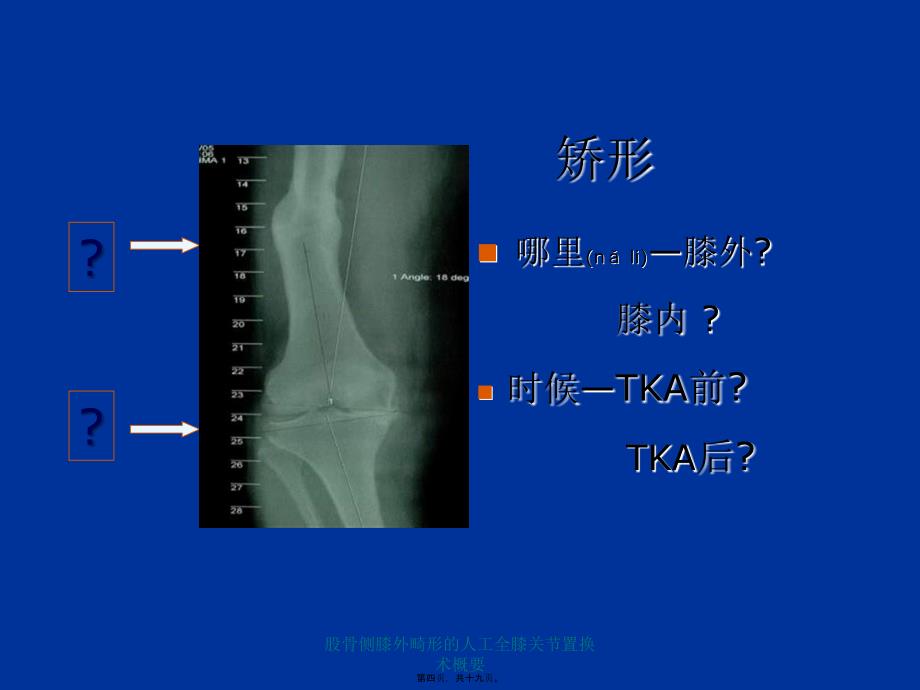 股骨侧膝外畸形的人工全膝关节置换术概要课件_第4页