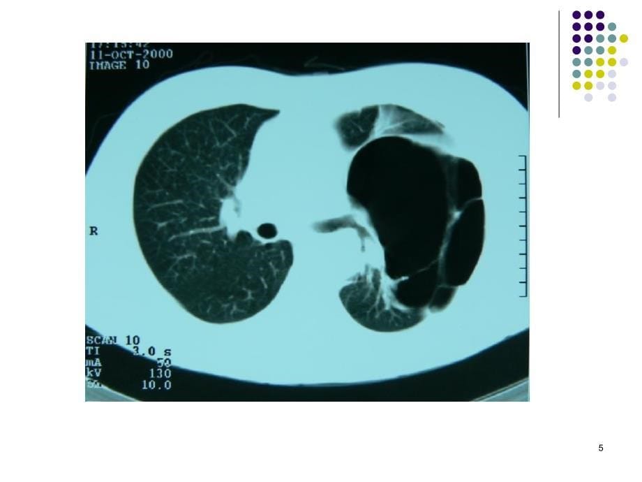 肺空洞性病变_第5页