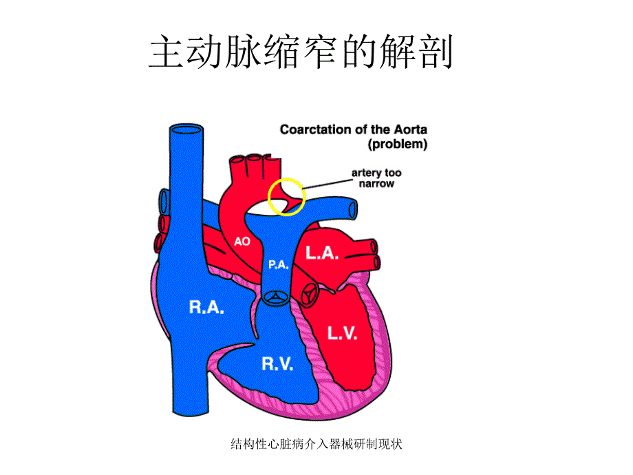 结构性心脏病介入器械研制现状课件_第3页