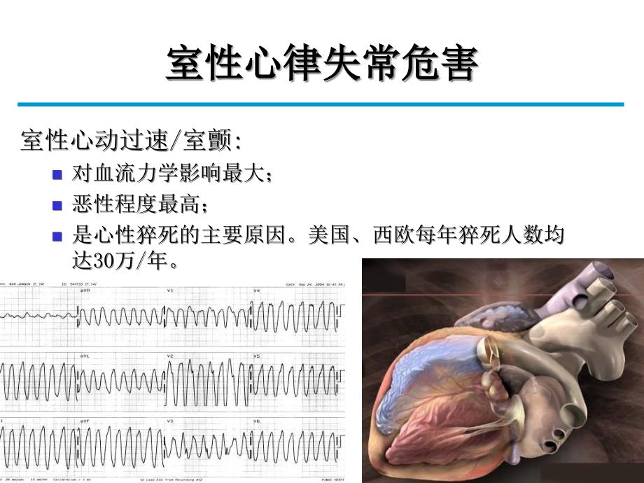 特发性室性心律失常消融治疗进展-医学课件_第2页