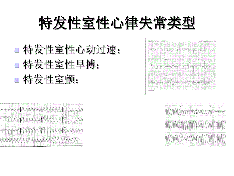 特发性室性心律失常消融治疗进展-医学课件_第4页