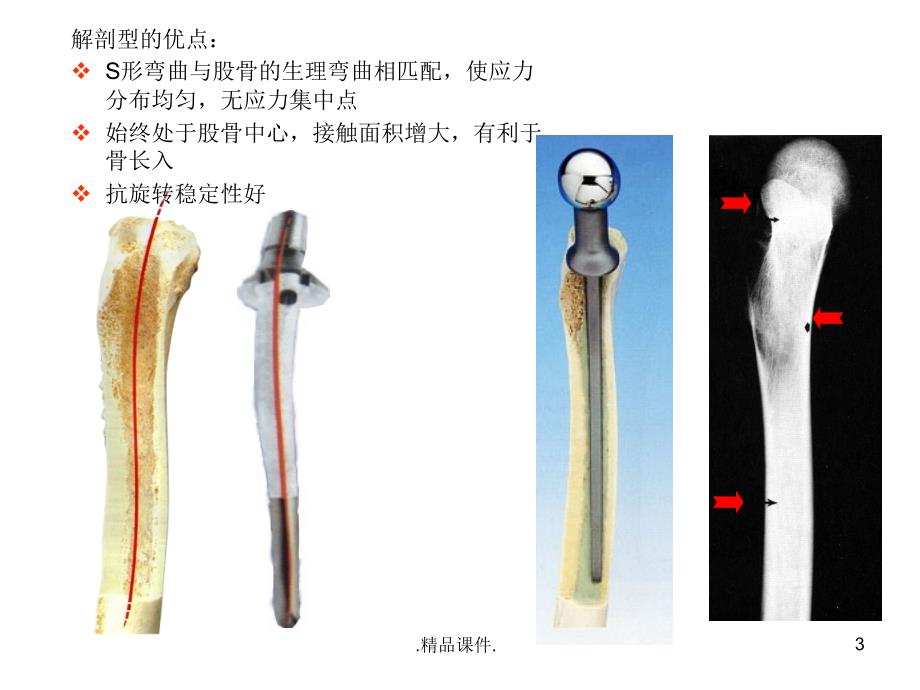 常用髋关节假体课件_第3页