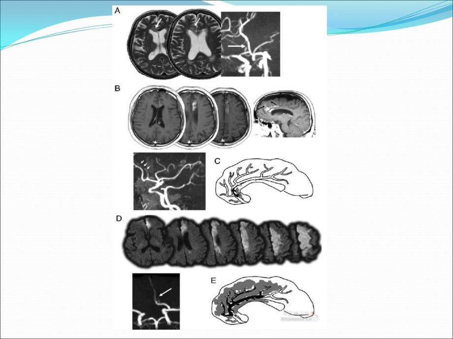 脑梗死责任血管分析_第4页