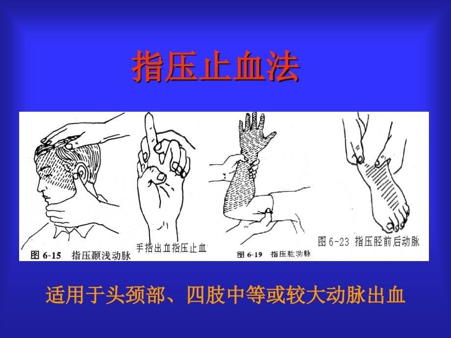 外伤急救技术止血包扎固定搬运_第5页