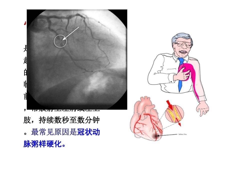 药理学-抗心绞痛药课件_第5页