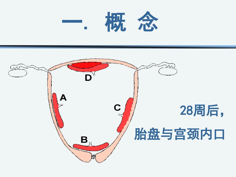 前置胎盘护理课件_第3页