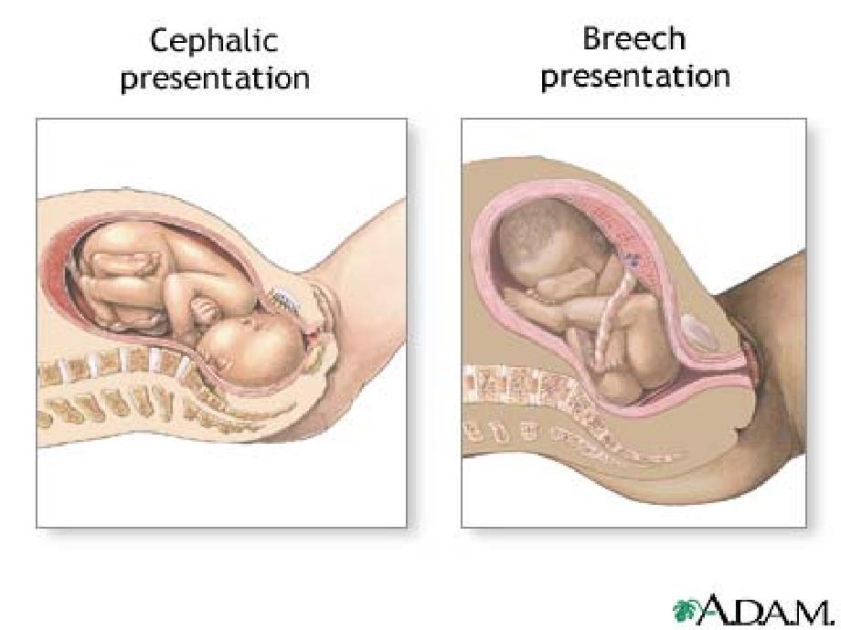 胎位异常课件_第3页