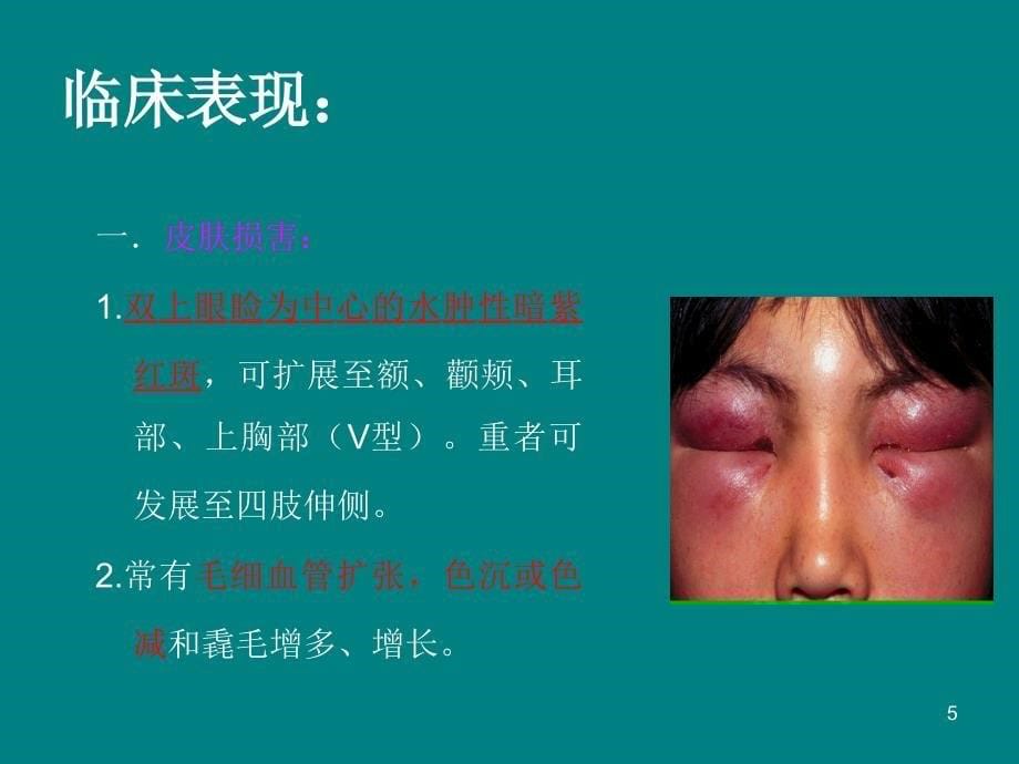 傅健介绍——皮肌炎的临床特点_第5页