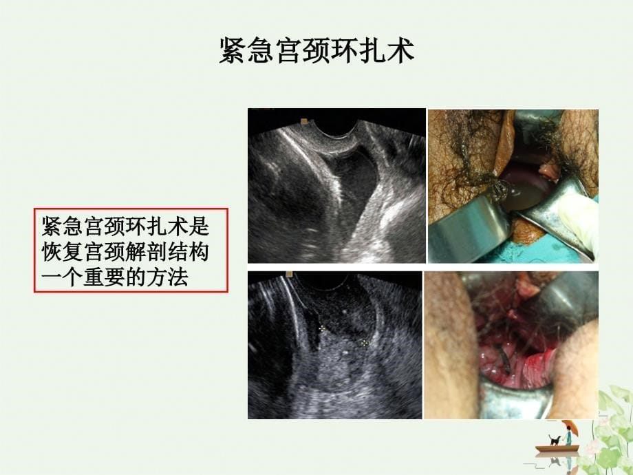 紧急宫颈环扎术的手术指征及术后管理讲课课件_第5页