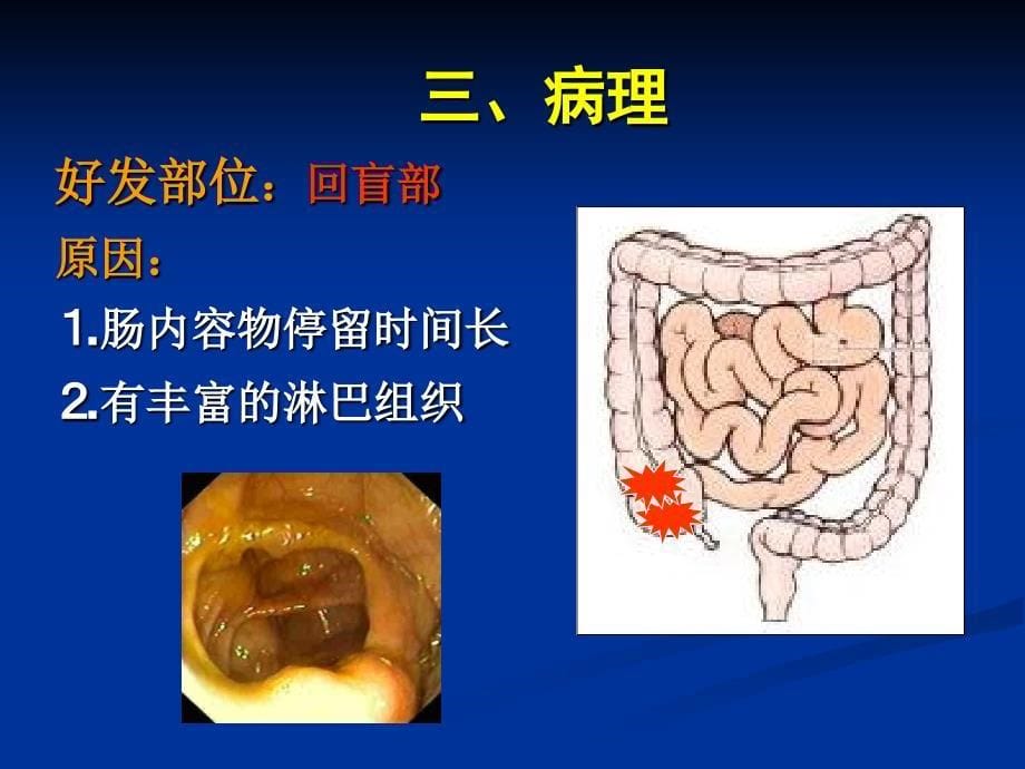 肠结核病人的护理PPT课件_第5页