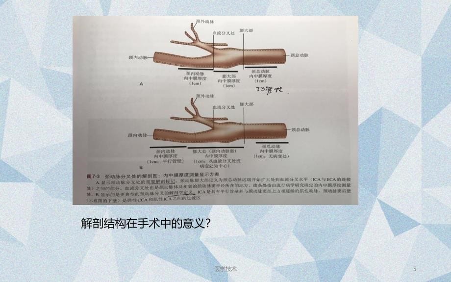 颈动脉超声与TCCD医学技术_第5页