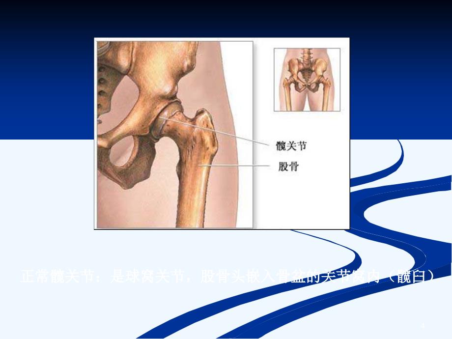 全髋关节置换术护理查房ppt课件_第4页