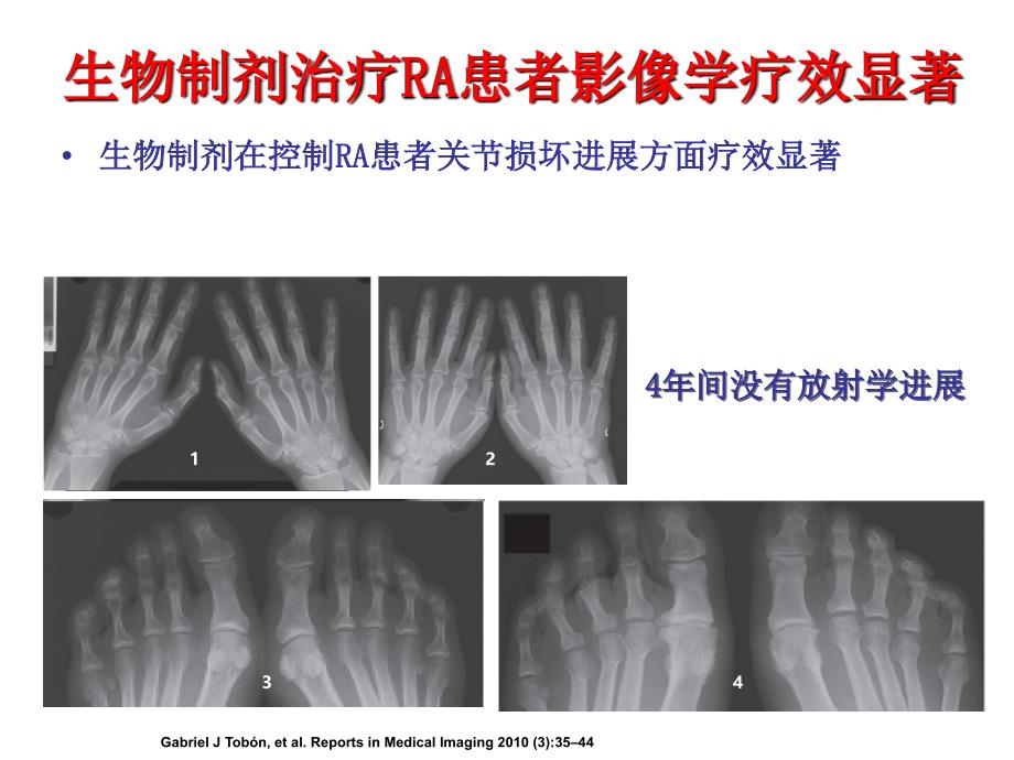 AS的治疗策略_第3页