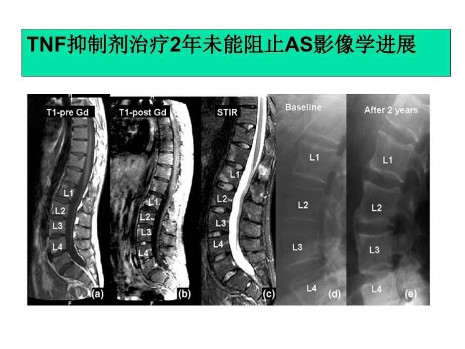 AS的治疗策略_第5页