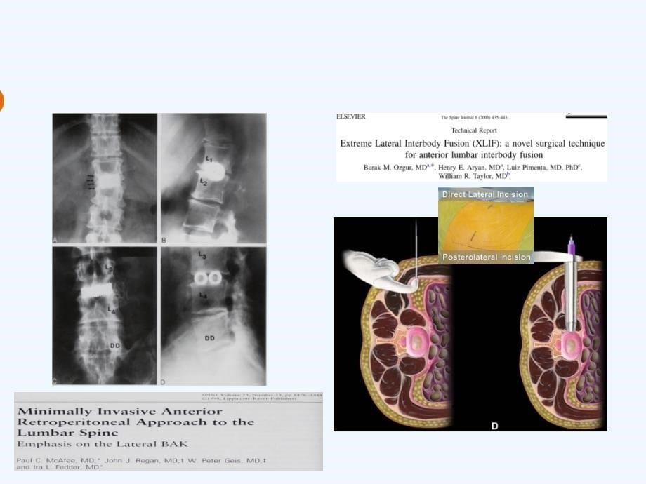 OLIF入路和相关解剖课件_第5页