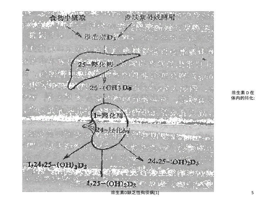 维生素D缺乏性佝偻病[1]_第5页