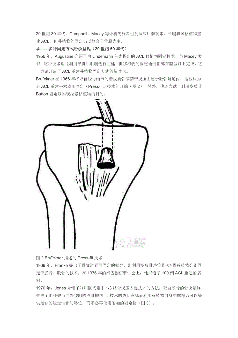 前交叉韧带重建固定技术——前世今生.doc_第2页