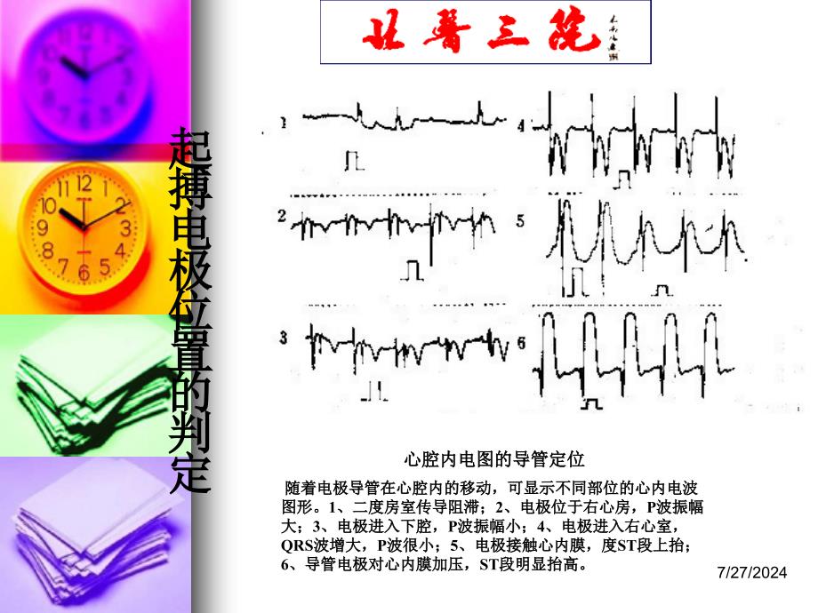 起搏心电图识别 ppt课件_第2页