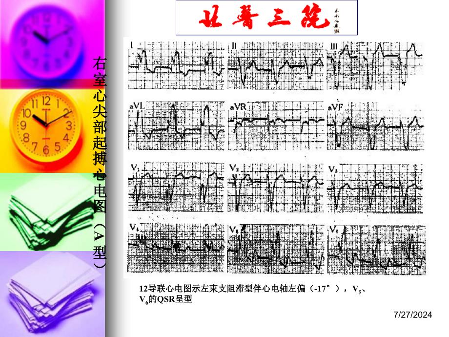 起搏心电图识别 ppt课件_第3页