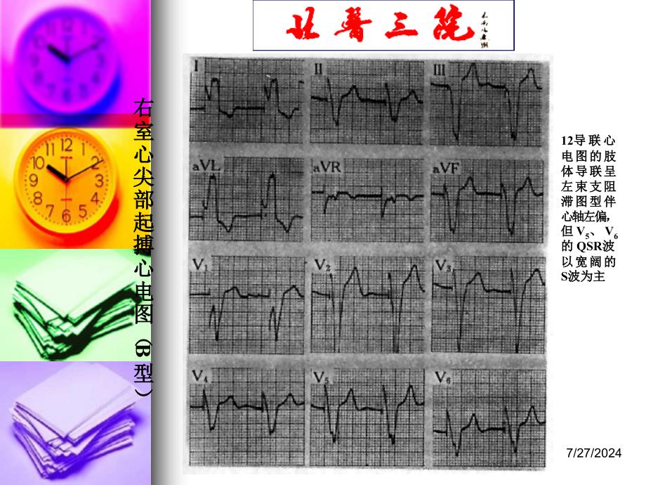 起搏心电图识别 ppt课件_第4页