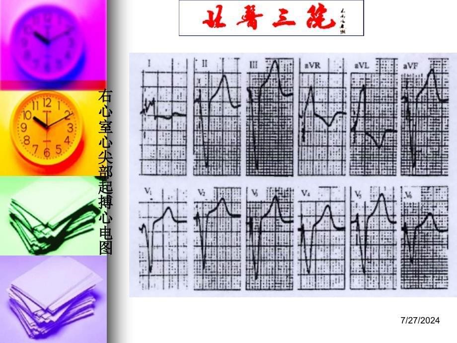 起搏心电图识别 ppt课件_第5页