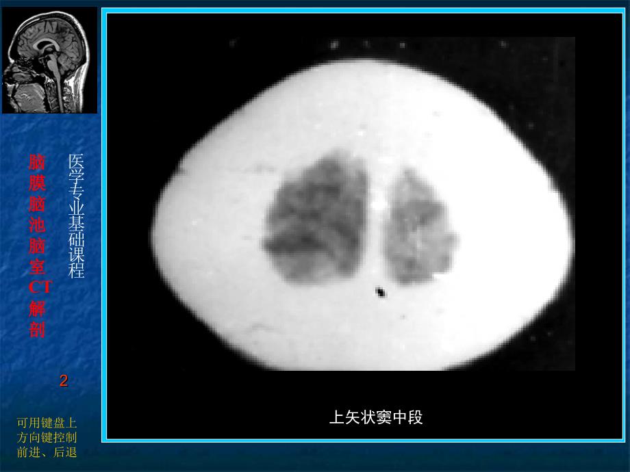 脑膜脑池脑室CT解剖课堂PPT_第2页