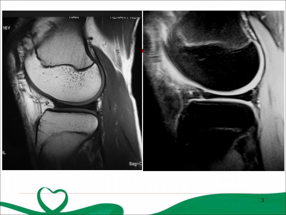 膝关节正常MRI表现及损伤诊断ppt参考课件_第3页