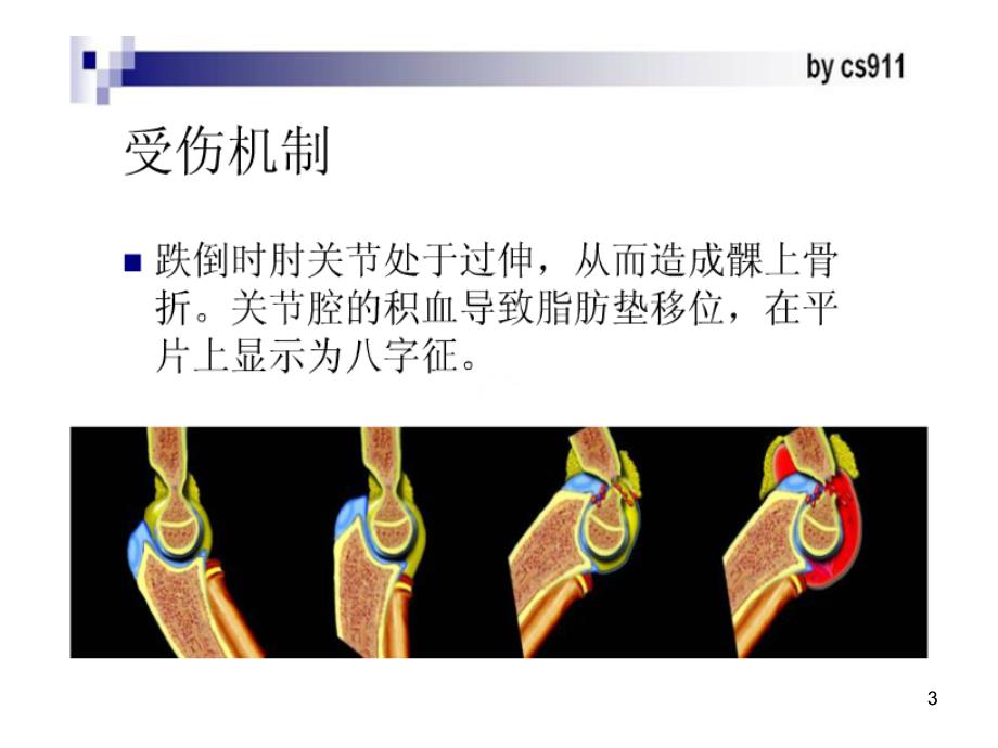 儿童肘关节外伤的X线诊断PPT精品文档_第3页