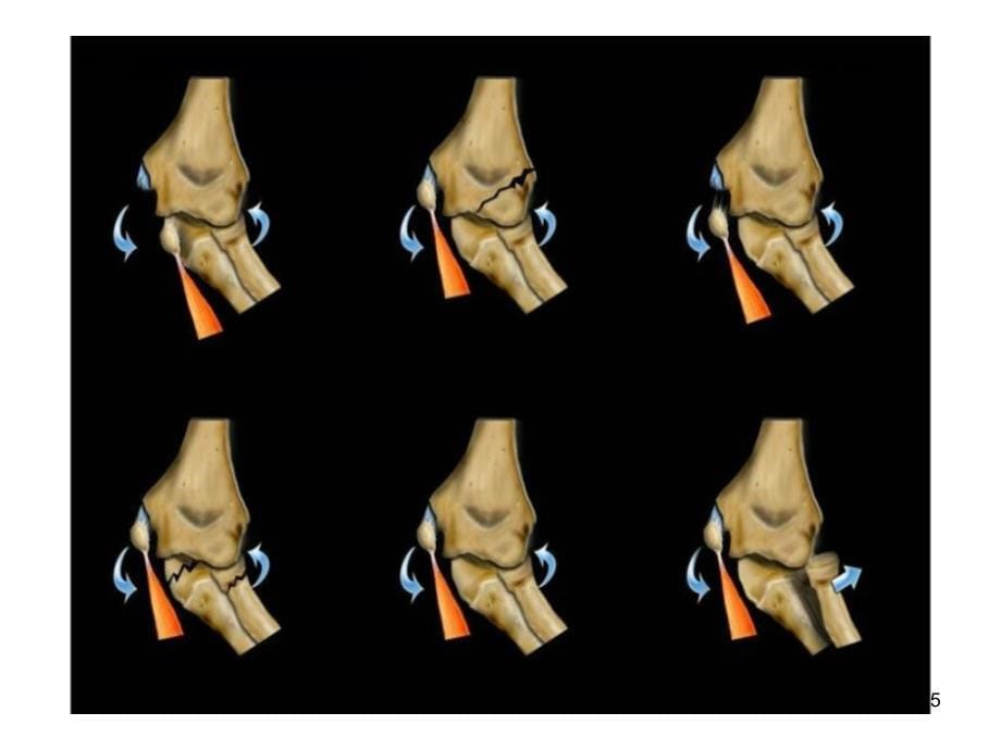 儿童肘关节外伤的X线诊断PPT精品文档_第5页
