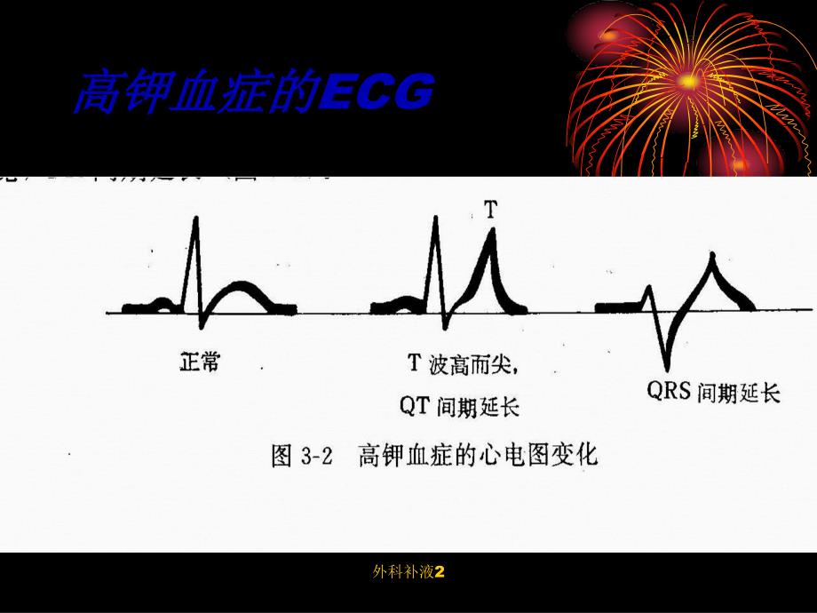 外科补液2课件_第4页