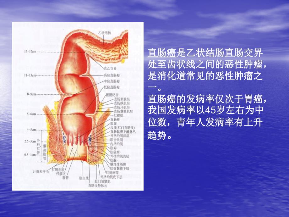 直肠癌术后护理查房课件_第4页