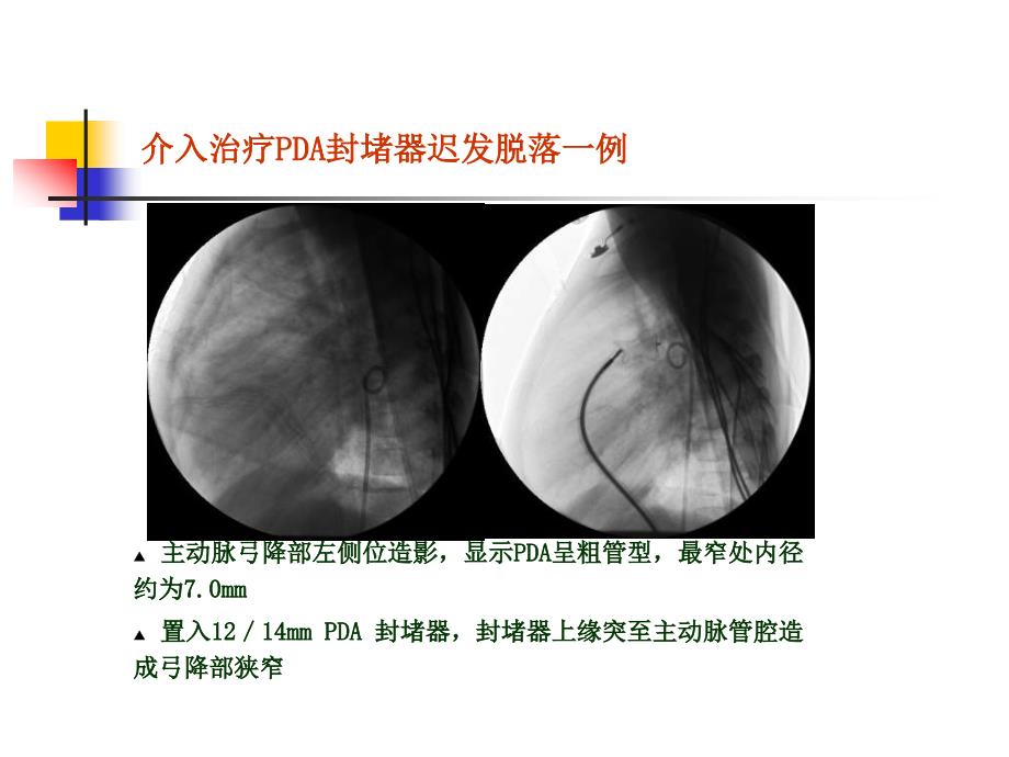 先心病介入治疗封堵器脱落3例分析王震_第3页