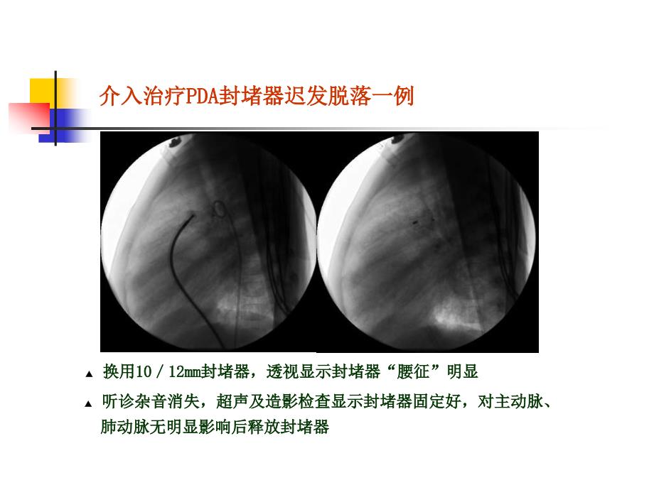 先心病介入治疗封堵器脱落3例分析王震_第4页