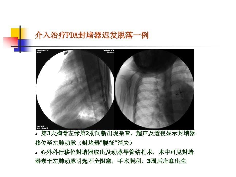 先心病介入治疗封堵器脱落3例分析王震_第5页