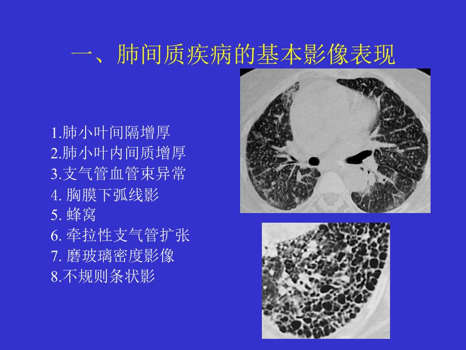 间质性肺疾病的CT诊断_第2页