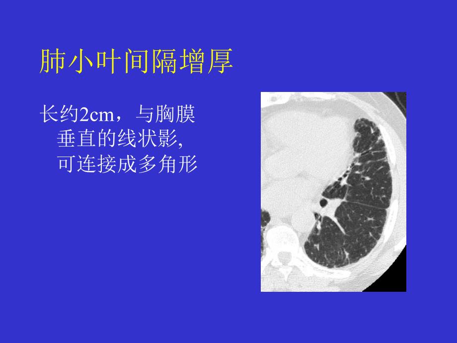 间质性肺疾病的CT诊断_第3页