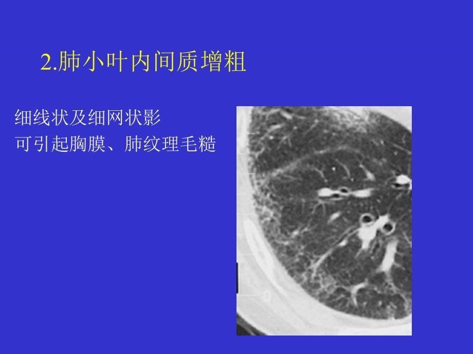 间质性肺疾病的CT诊断_第5页