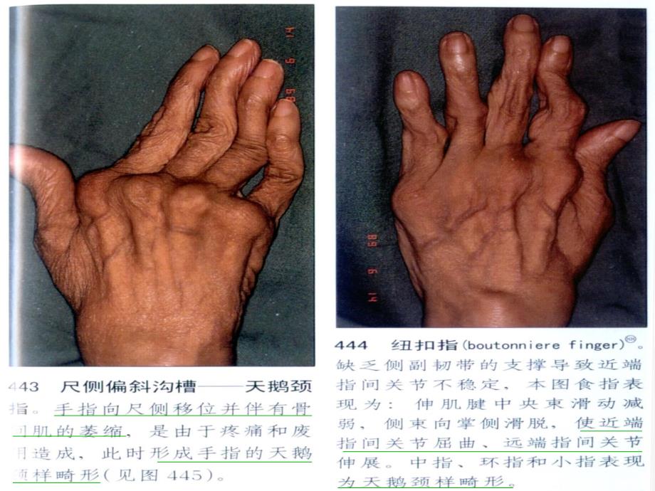 类风湿性关节炎中医治疗方案介绍医学PPT课件_第5页