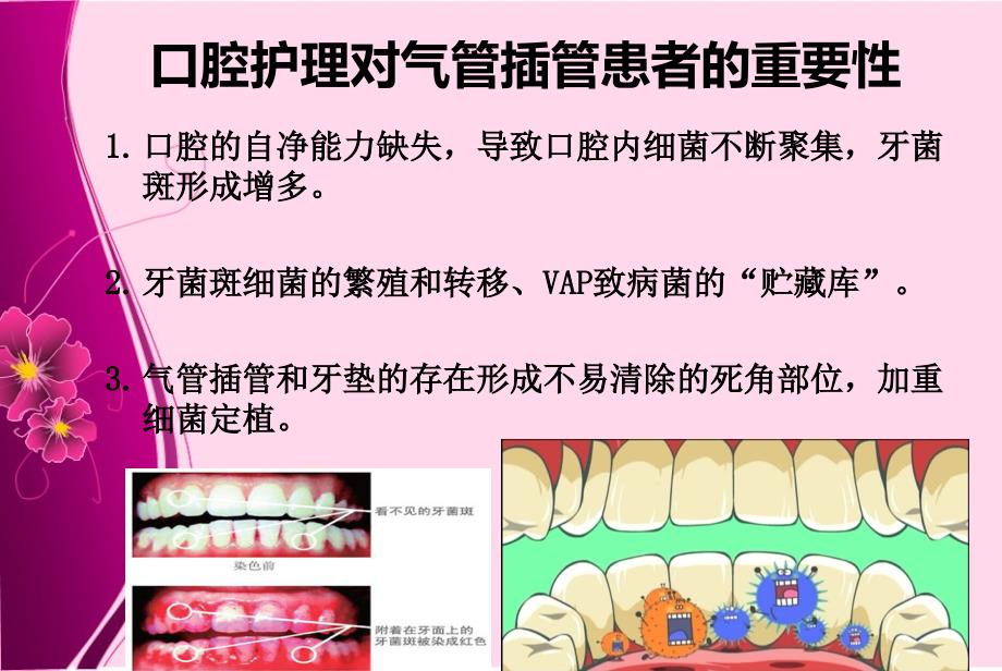 气管插管病人的口腔护理ppt_第4页