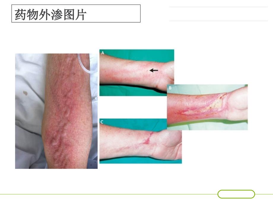 化疗药外渗处理教学内容_第3页