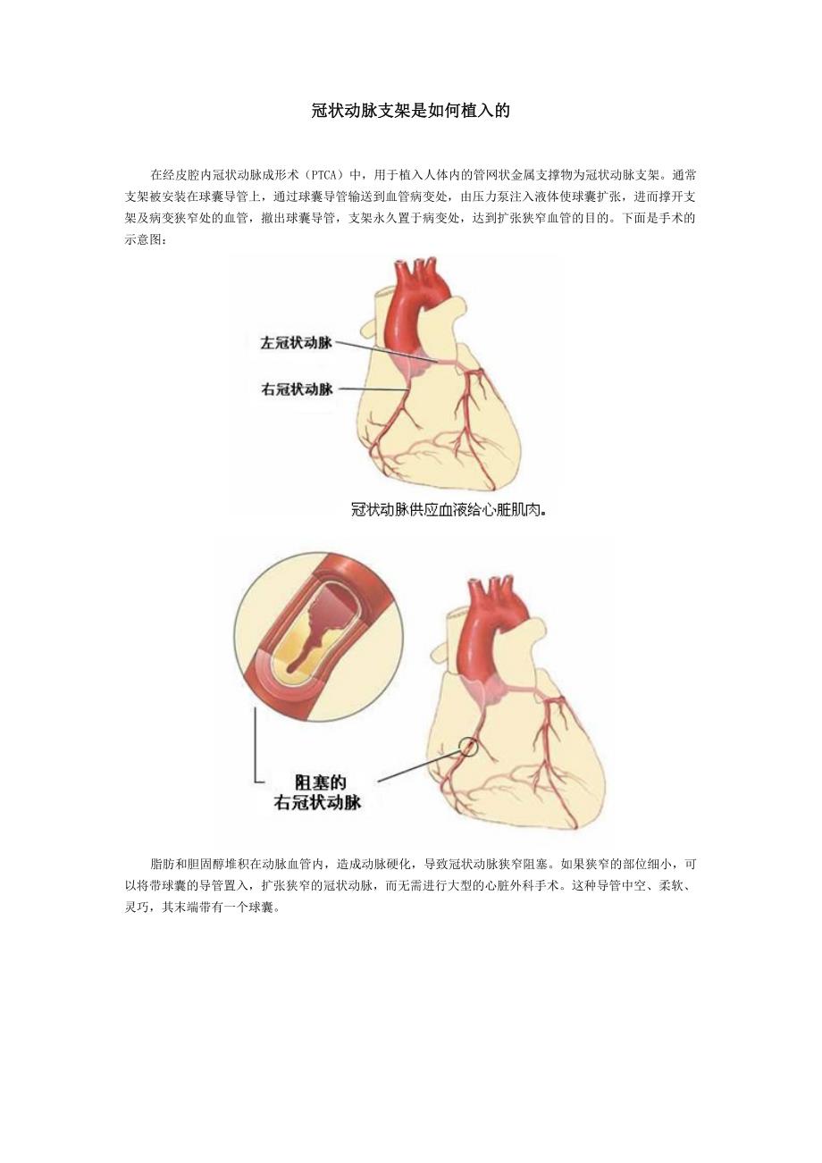 医学专题：冠状动脉支架是如何植入的_第1页