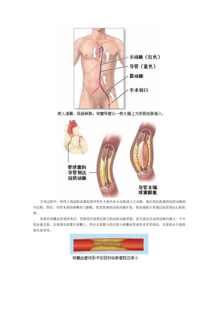 医学专题：冠状动脉支架是如何植入的_第2页