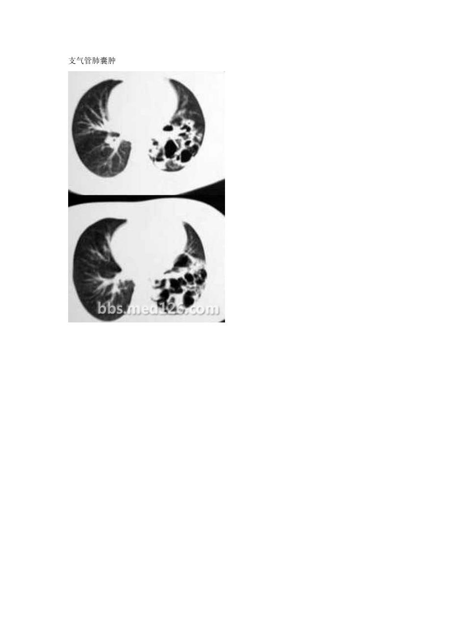 囊性支气管扩张和支气管肺囊肿的影像区别_第3页