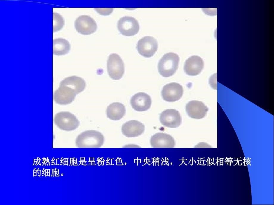 溶血性贫血诊断与鉴别诊断课件_第5页